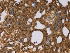 PSMC2 / RPT1 Antibody - Immunohistochemistry of paraffin-embedded Human cervical cancer using PSMC2 Polyclonal Antibody at dilution of 1:30.