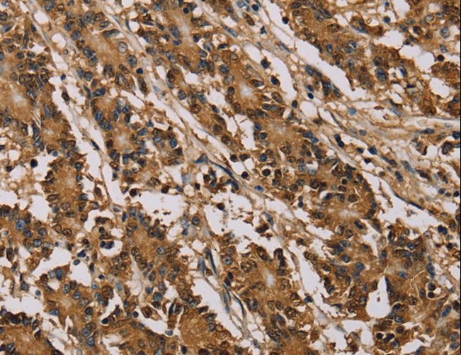 PSMC2 / RPT1 Antibody - Immunohistochemistry of paraffin-embedded Human colon cancer using PSMC2 Polyclonal Antibody at dilution of 1:30.