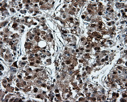 PSMC3 Antibody - IHC of paraffin-embedded Carcinoma of liver tissue using anti-PSMC3 mouse monoclonal antibody. (Dilution 1:50).