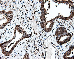 PSMC3 Antibody - IHC of paraffin-embedded Carcinoma of prostate tissue using anti-PSMC3 mouse monoclonal antibody. (Dilution 1:50).