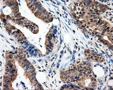 PSMC3 Antibody - IHC of paraffin-embedded Adenocarcinoma of colon tissue using anti-PSMC3 mouse monoclonal antibody. (Dilution 1:50).