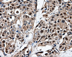 PSMC3 Antibody - IHC of paraffin-embedded Adenocarcinoma of breast tissue using anti-PSMC3 mouse monoclonal antibody. (Dilution 1:50).