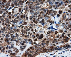 PSMC3 Antibody - IHC of paraffin-embedded Adenocarcinoma of ovary tissue using anti-PSMC3 mouse monoclonal antibody. (Dilution 1:50).