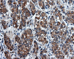 PSMC3 Antibody - IHC of paraffin-embedded Carcinoma of liver tissue using anti-PSMC3 mouse monoclonal antibody. (Dilution 1:50).