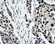 PSMC3 Antibody - Immunohistochemical staining of paraffin-embedded Adenocarcinoma of breast tissue using anti-PSMC3 mouse monoclonal antibody. (Dilution 1:50).