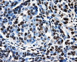 PSMC3 Antibody - Immunohistochemical staining of paraffin-embedded Adenocarcinoma of ovary tissue using anti-PSMC3 mouse monoclonal antibody. (Dilution 1:50).