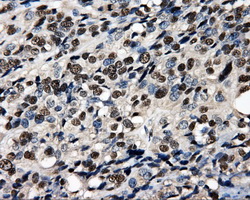 PSMC3 Antibody - Immunohistochemical staining of paraffin-embedded Carcinoma of bladder tissue using anti-PSMC3 mouse monoclonal antibody. (Dilution 1:50).