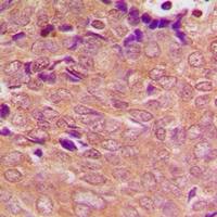 PSMC3 Antibody - Immunohistochemical analysis of PSMC3 staining in human breast cancer formalin fixed paraffin embedded tissue section. The section was pre-treated using heat mediated antigen retrieval with sodium citrate buffer (pH 6.0). The section was then incubated with the antibody at room temperature and detected with HRP and DAB as chromogen. The section was then counterstained with hematoxylin and mounted with DPX.