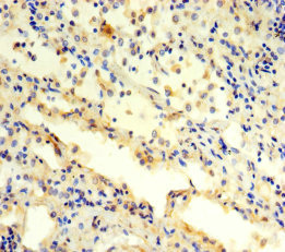 PSMC3 Antibody - Immunohistochemistry of paraffin-embedded human lung cancer using PSMC3 Antibody at dilution of 1:100