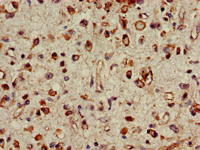 PSMC4 Antibody - Immunohistochemistry Dilution at 1:500 and staining in paraffin-embedded human glioma cancer performed on a Leica BondTM system. After dewaxing and hydration, antigen retrieval was mediated by high pressure in a citrate buffer (pH 6.0). Section was blocked with 10% normal Goat serum 30min at RT. Then primary antibody (1% BSA) was incubated at 4°C overnight. The primary is detected by a biotinylated Secondary antibody and visualized using an HRP conjugated SP system.