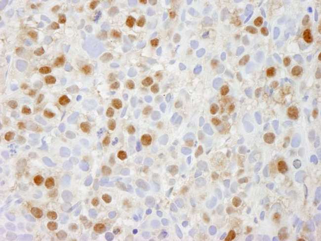 PSMC5 / SUG1 Antibody - Detection of Human TRIP1/SUG1 by Immunohistochemistry. Sample: FFPE section of human metastatic bone marrow. Antibody: Affinity purified rabbit anti-TRIP1/SUG1 used at a dilution of 1:250.