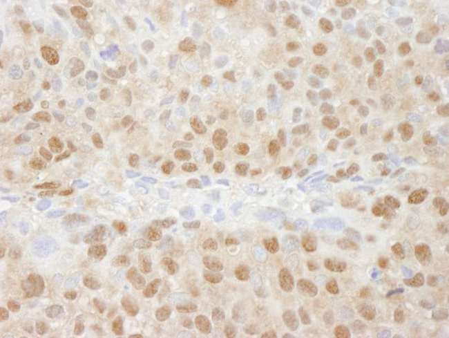 PSMC5 / SUG1 Antibody - Detection of Human TRIP1/SUG1 by Immunohistochemistry. Sample: FFPE section of human breast tumor. Antibody: Affinity purified rabbit anti-TRIP1/SUG1 used at a dilution of 1:250.