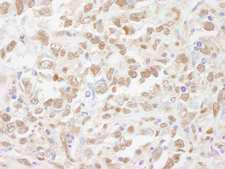 PSMC5 / SUG1 Antibody - Detection of Human TRIP1(SUG1) by Immunohistochemistry. Sample: FFPE section of human metastatic lymph node. Antibody: Affinity purified rabbit anti-TRIP1(SUG1) used at a dilution of 1:200 (1 ug/ml). Detection: DAB.