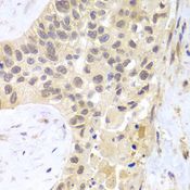 PSMC5 / SUG1 Antibody - Immunohistochemistry of paraffin-embedded human lung cancer using PSMC5 antibody at dilution of 1:100 (40x lens).