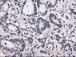 PSMD10 / Gankyrin Antibody - IHC of paraffin-embedded Adenocarcinoma of colon tissue using anti-PSMD10 mouse monoclonal antibody. (Dilution 1:50).