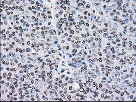 PSMD10 / Gankyrin Antibody - IHC of paraffin-embedded Adenocarcinoma of endometrium tissue using anti-PSMD10 mouse monoclonal antibody. (Dilution 1:50).