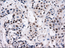 PSMD10 / Gankyrin Antibody - IHC of paraffin-embedded Adenocarcinoma of breast tissue using anti-PSMD10 mouse monoclonal antibody. (Dilution 1:50).