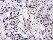 PSMD10 / Gankyrin Antibody - IHC of paraffin-embedded Adenocarcinoma of breast tissue using anti-PSMD10 mouse monoclonal antibody. (Dilution 1:50).