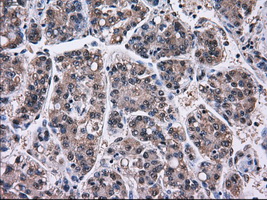 PSMD10 / Gankyrin Antibody - IHC of paraffin-embedded Carcinoma of liver tissue using anti-PSMD10 mouse monoclonal antibody. (Dilution 1:50).