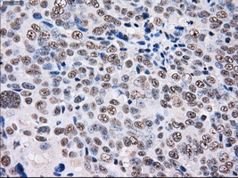 PSMD10 / Gankyrin Antibody - IHC of paraffin-embedded Adenocarcinoma of ovary tissue using anti-PSMD10 mouse monoclonal antibody. (Dilution 1:50).