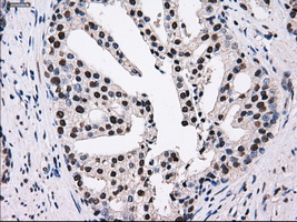 PSMD10 / Gankyrin Antibody - IHC of paraffin-embedded Carcinoma of prostate tissue using anti-PSMD10 mouse monoclonal antibody. (Dilution 1:50).