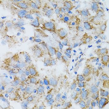PSMD10 / Gankyrin Antibody - Immunohistochemistry of paraffin-embedded human breast cancer tissue.