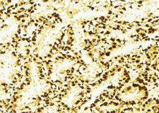 PSMD10 / Gankyrin Antibody - 1:100 staining human lung tissue by IHC-P. The sample was formaldehyde fixed and a heat mediated antigen retrieval step in citrate buffer was performed. The sample was then blocked and incubated with the antibody for 1.5 hours at 22°C. An HRP conjugated goat anti-rabbit antibody was used as the secondary.