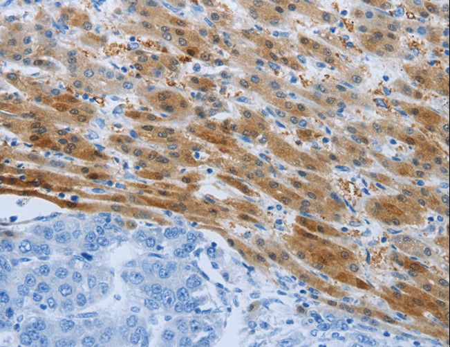 PSMD11 Antibody - Immunohistochemistry of paraffin-embedded Human liver cancer using PSMD11 Polyclonal Antibody at dilution of 1:50.