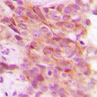 PSMD12 / Rpn5 Antibody - Immunohistochemical analysis of PSMD12 staining in human breast cancer formalin fixed paraffin embedded tissue section. The section was pre-treated using heat mediated antigen retrieval with sodium citrate buffer (pH 6.0). The section was then incubated with the antibody at room temperature and detected using an HRP conjugated compact polymer system. DAB was used as the chromogen. The section was then counterstained with hematoxylin and mounted with DPX.