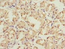 PSMD12 / Rpn5 Antibody - Immunohistochemistry of paraffin-embedded human gastric cancer at dilution 1:100