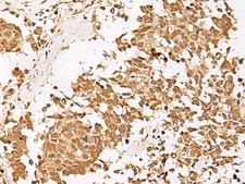 PSMD12 / Rpn5 Antibody - Immunohistochemistry of paraffin-embedded Human lung cancer tissue  using PSMD12 Polyclonal Antibody at dilution of 1:40(×200)