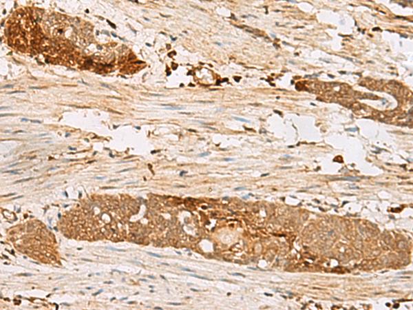 PSMD12 / Rpn5 Antibody - Immunohistochemistry of paraffin-embedded Human esophagus cancer tissue  using PSMD12 Polyclonal Antibody at dilution of 1:50(×200)