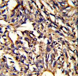 PSMD13 Antibody - Formalin-fixed and paraffin-embedded human lung carcinoma reacted with PSMD13 Antibody , which was peroxidase-conjugated to the secondary antibody, followed by DAB staining. This data demonstrates the use of this antibody for immunohistochemistry; clinical relevance has not been evaluated.
