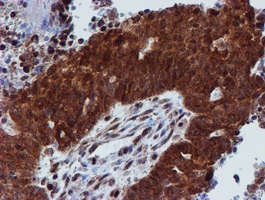 PSMD2 Antibody - IHC of paraffin-embedded Adenocarcinoma of Human ovary tissue using anti-PSMD2 mouse monoclonal antibody.
