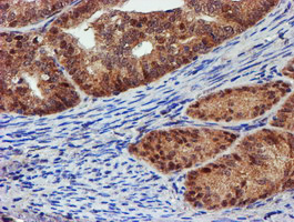 PSMD2 Antibody - IHC of paraffin-embedded Adenocarcinoma of Human endometrium tissue using anti-PSMD2 mouse monoclonal antibody.