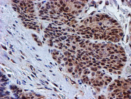 PSMD2 Antibody - IHC of paraffin-embedded Carcinoma of Human bladder tissue using anti-PSMD2 mouse monoclonal antibody.