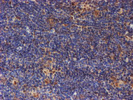 PSMD2 Antibody - IHC of paraffin-embedded Human lymphoma tissue using anti-PSMD2 mouse monoclonal antibody.