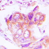 PSMD2 Antibody - Immunohistochemical analysis of PSMD2 staining in human lung cancer formalin fixed paraffin embedded tissue section. The section was pre-treated using heat mediated antigen retrieval with sodium citrate buffer (pH 6.0). The section was then incubated with the antibody at room temperature and detected using an HRP conjugated compact polymer system. DAB was used as the chromogen. The section was then counterstained with hematoxylin and mounted with DPX.