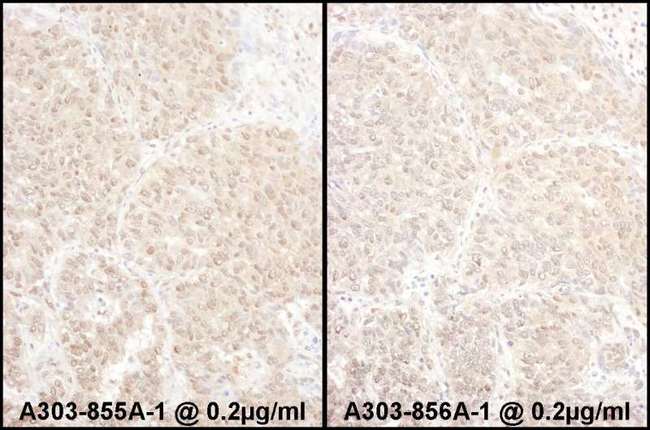 PSMD4 / RPN10 Antibody - Detection of Human PSMD4 by Immunohistochemistry. Samples: FFPE sections of human lung carcinoma. Antibody: Affinity purified rabbit anti-PSMD4 used at a dilution of 1:5000. Detection: DAB.