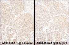 PSMD4 / RPN10 Antibody - Detection of Human PSMD4 by Immunohistochemistry. Samples: FFPE sections of human lung carcinoma. Antibody: Affinity purified rabbit anti-PSMD4 used at a dilution of 1:5000. Detection: DAB.