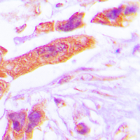 PSMD6 Antibody - Immunohistochemical analysis of PSMD6 staining in human lung cancer formalin fixed paraffin embedded tissue section. The section was pre-treated using heat mediated antigen retrieval with sodium citrate buffer (pH 6.0). The section was then incubated with the antibody at room temperature and detected using an HRP conjugated compact polymer system. DAB was used as the chromogen. The section was then counterstained with hematoxylin and mounted with DPX.