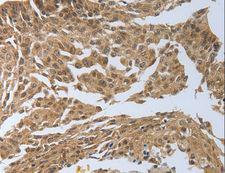 PSMD6 Antibody - Immunohistochemistry of paraffin-embedded Human cervical cancer using PSMD6 Polyclonal Antibody at dilution of 1:40.