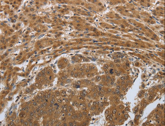 PSMD6 Antibody - Immunohistochemistry of paraffin-embedded Human liver cancer using PSMD6 Polyclonal Antibody at dilution of 1:50.