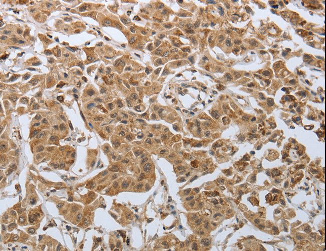 PSMD6 Antibody - Immunohistochemistry of paraffin-embedded Human lung cancer using PSMD6 Polyclonal Antibody at dilution of 1:50.
