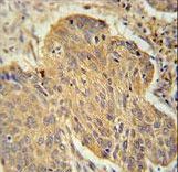 PSMD7 / MOV34 Antibody - PSMD7 Antibody immunohistochemistry of formalin-fixed and paraffin-embedded human lung carcinoma followed by peroxidase-conjugated secondary antibody and DAB staining.