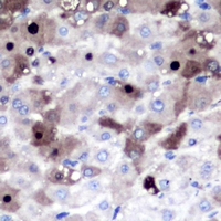 PSMD8 / RPN12 Antibody - Immunohistochemical analysis of PSMD8 staining in human liver cancer formalin fixed paraffin embedded tissue section. The section was pre-treated using heat mediated antigen retrieval with sodium citrate buffer (pH 6.0). The section was then incubated with the antibody at room temperature and detected using an HRP conjugated compact polymer system. DAB was used as the chromogen. The section was then counterstained with hematoxylin and mounted with DPX.