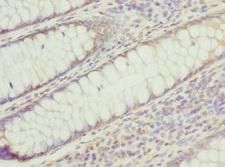 PSMD8 / RPN12 Antibody - Immunohistochemistry of paraffin-embedded human colon cancer at dilution 1:100