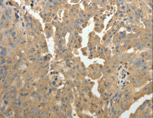 PSMD9 / 26S Proteasome Antibody - Immunohistochemistry of paraffin-embedded Human ovarian cancer using PSMD9 Polyclonal Antibody at dilution of 1:50.