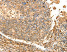 PSMD9 / 26S Proteasome Antibody - Immunohistochemistry of paraffin-embedded Human liver cancer using PSMD9 Polyclonal Antibody at dilution of 1:40.