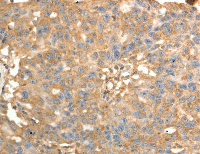 PSMD9 / 26S Proteasome Antibody - Immunohistochemistry of paraffin-embedded Human ovarian cancer using PSMD9 Polyclonal Antibody at dilution of 1:40.
